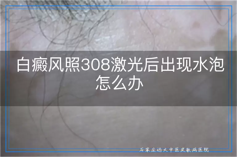 白癜风照308激光后出现水泡怎么办