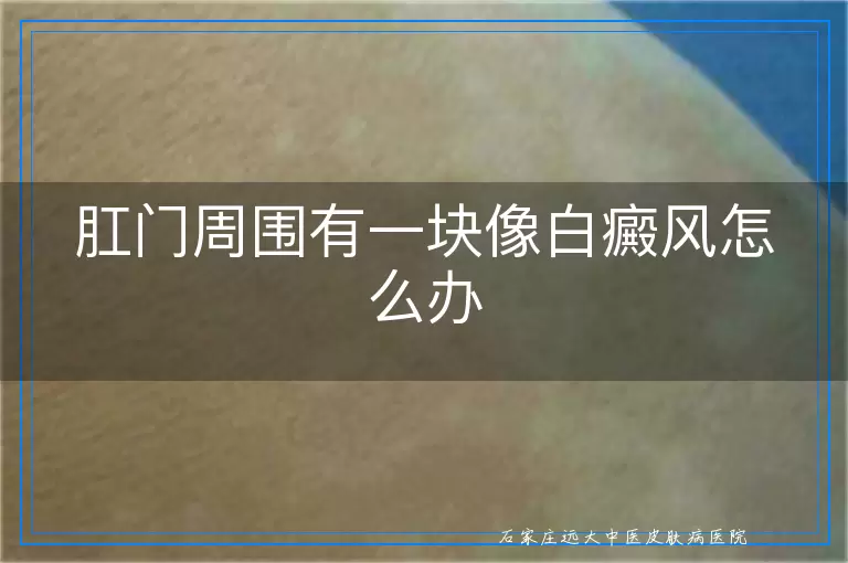 肛门周围有一块像白癜风怎么办