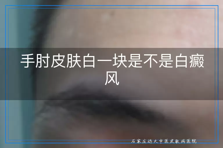 手肘皮肤白一块是不是白癜风