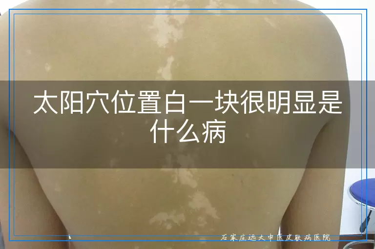 太阳穴位置白一块很明显是什么病