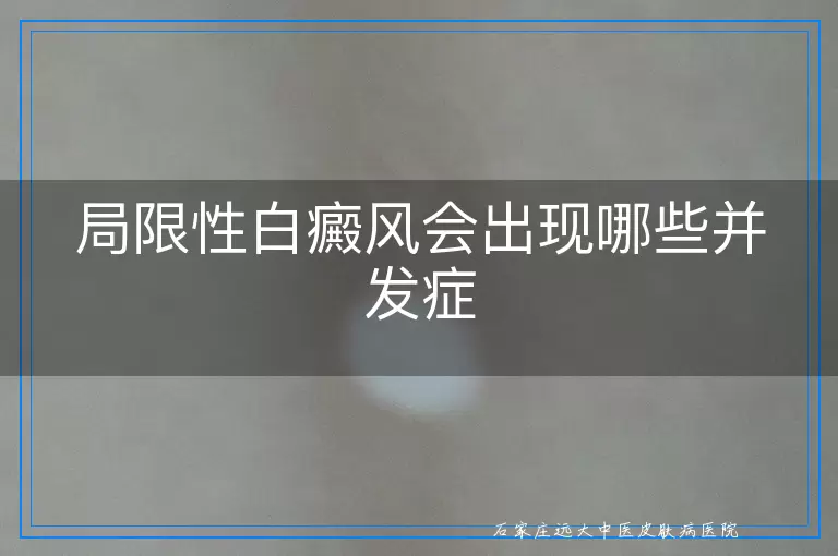 局限性白癜风会出现哪些并发症