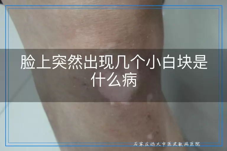 脸上突然出现几个小白块是什么病