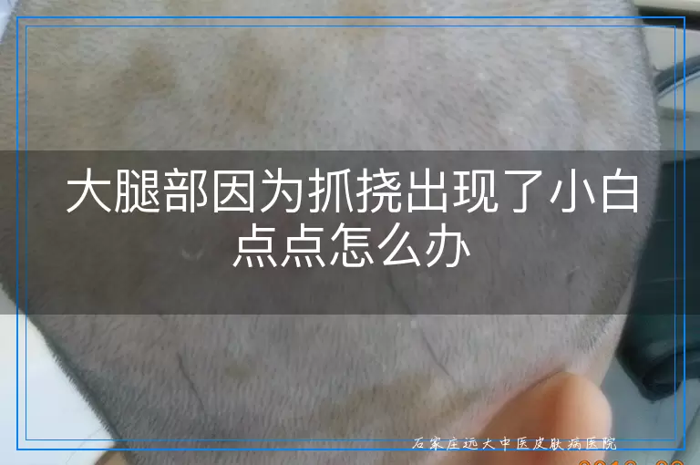 大腿部因为抓挠出现了小白点点怎么办