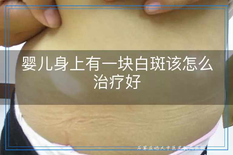 婴儿身上有一块白斑该怎么治疗好