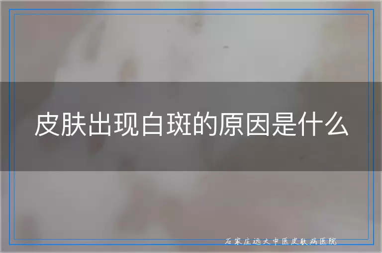 皮肤出现白斑的原因是什么
