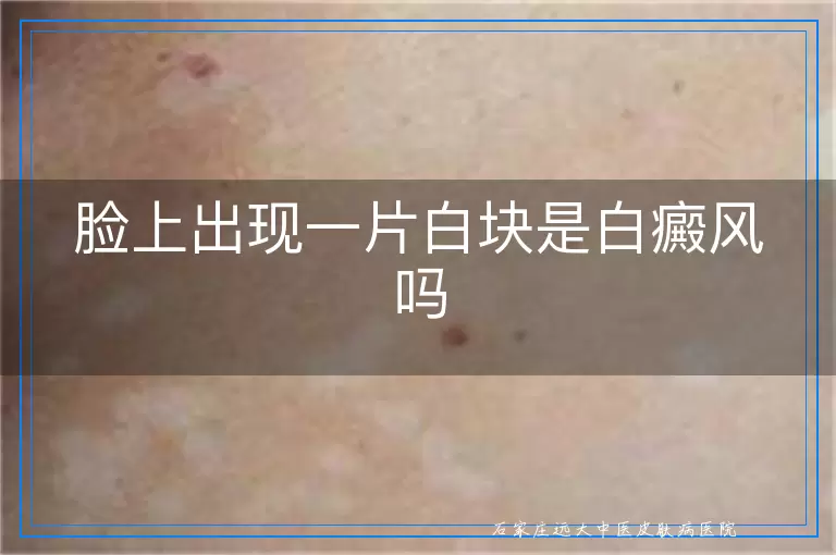 脸上出现一片白块是白癜风吗