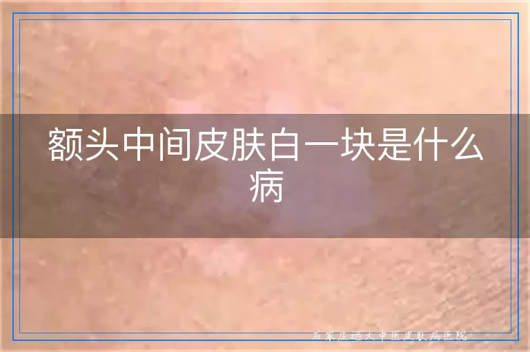 额头中间皮肤白一块是什么病