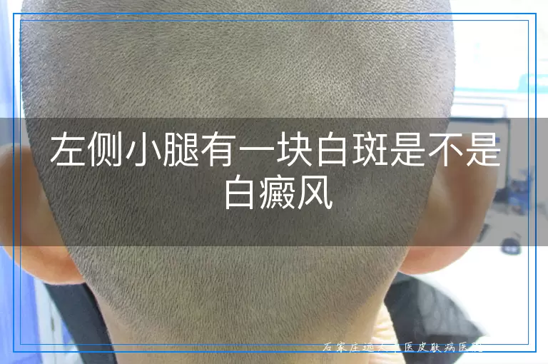 左侧小腿有一块白斑是不是白癜风