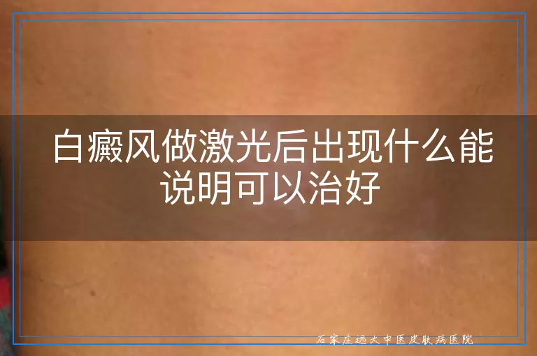白癜风做激光后出现什么能说明可以治好