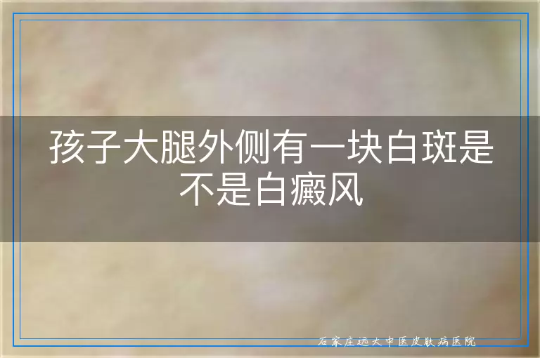 孩子大腿外侧有一块白斑是不是白癜风