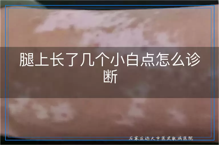 腿上长了几个小白点怎么诊断