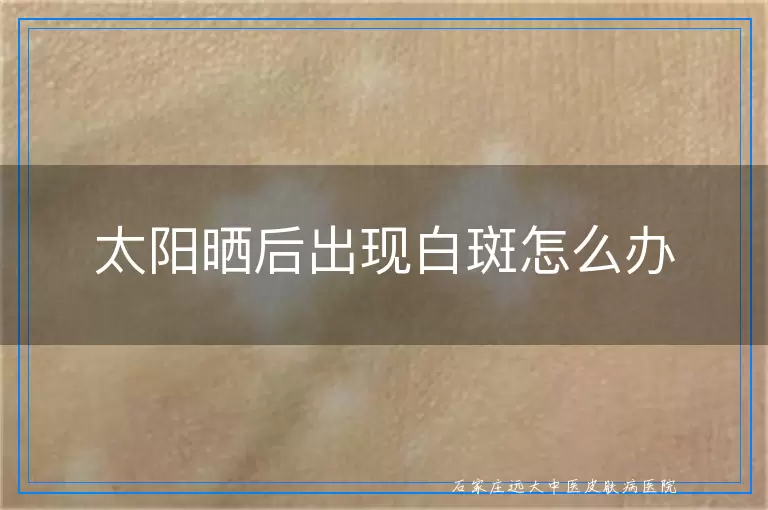 太阳晒后出现白斑怎么办