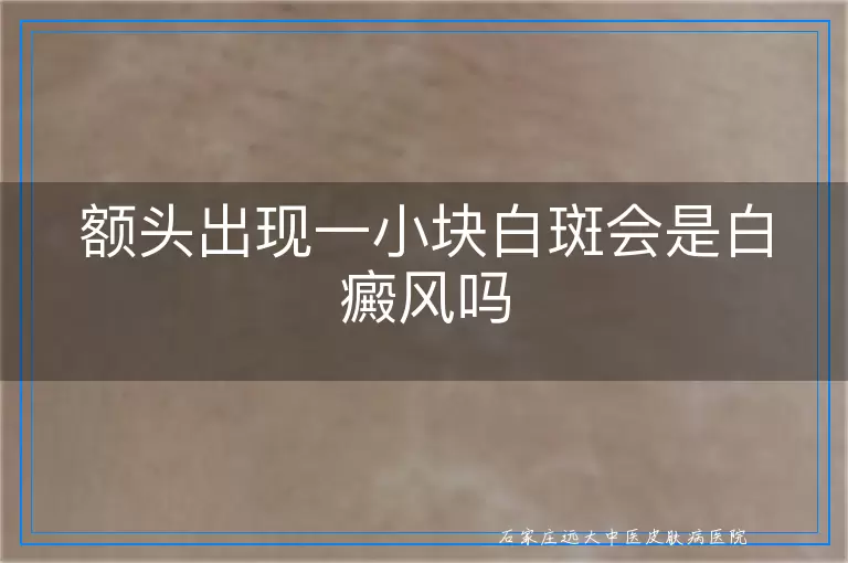 额头出现一小块白斑会是白癜风吗