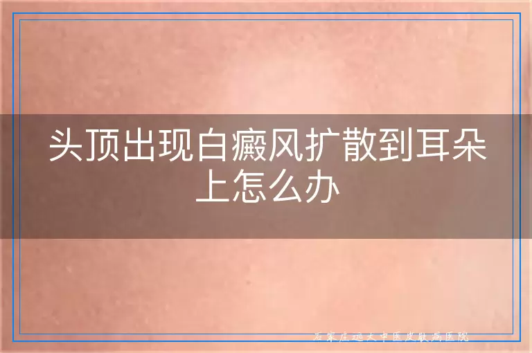 头顶出现白癜风扩散到耳朵上怎么办