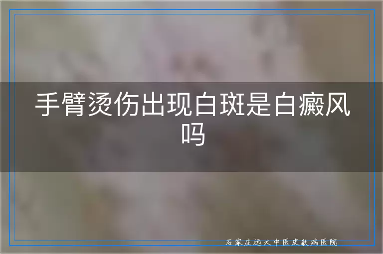 手臂烫伤出现白斑是白癜风吗