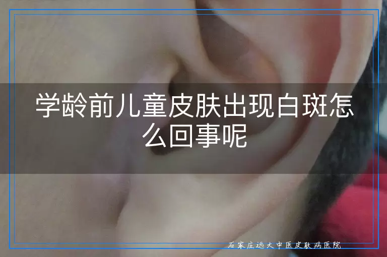 学龄前儿童皮肤出现白斑怎么回事呢