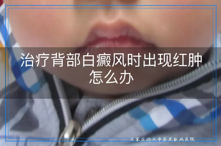 治疗背部白癜风时出现红肿怎么办