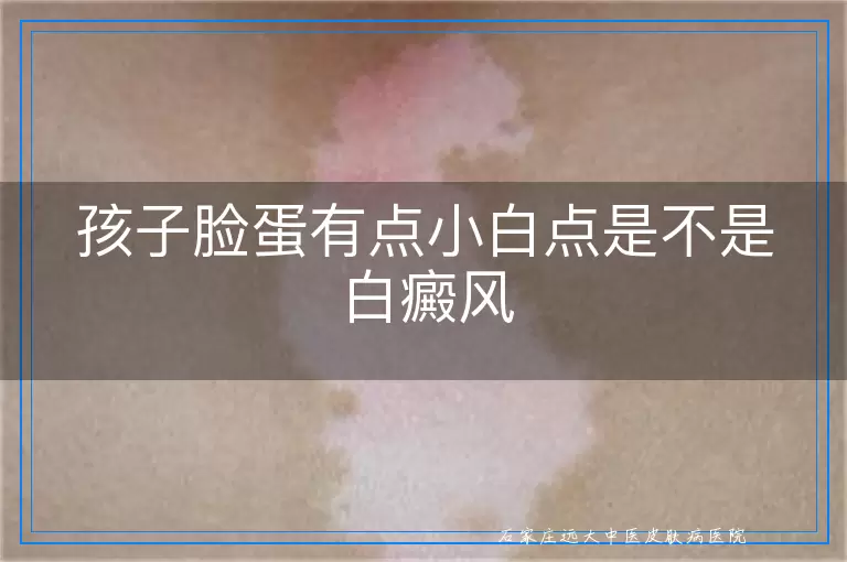 孩子脸蛋有点小白点是不是白癜风