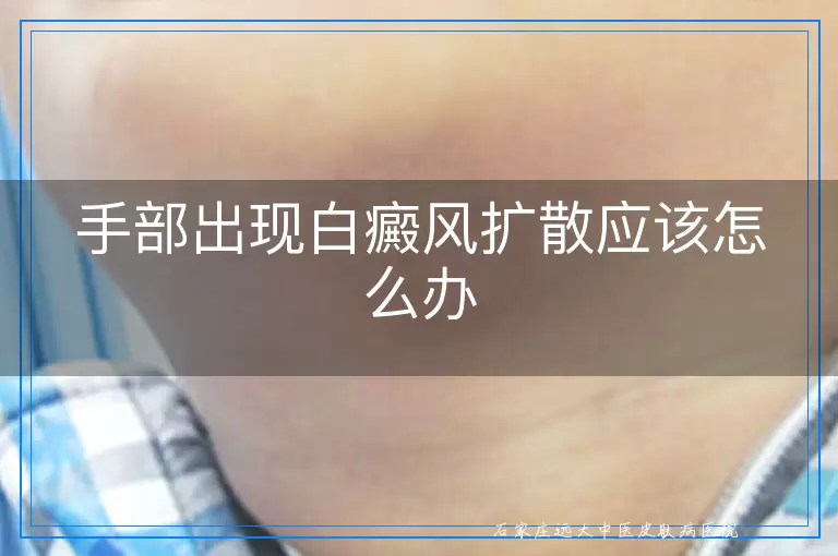 手部出现白癜风扩散应该怎么办