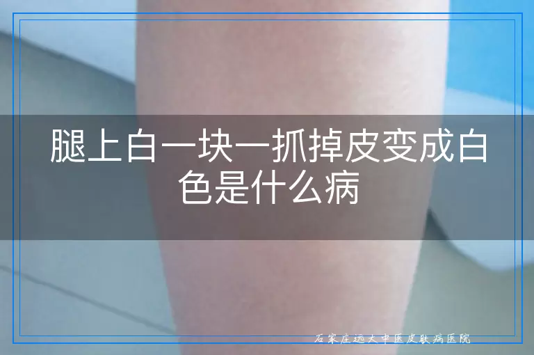 腿上白一块一抓掉皮变成白色是什么病