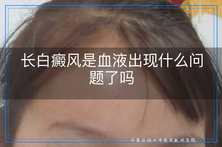 长白癜风是血液出现什么问题了吗