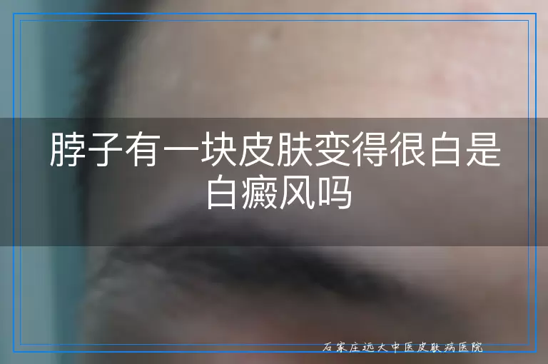 脖子有一块皮肤变得很白是白癜风吗