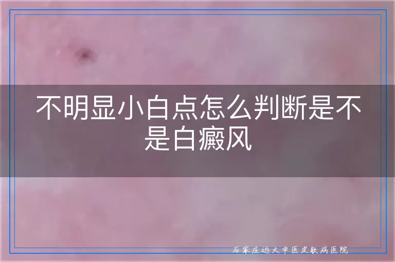 不明显小白点怎么判断是不是白癜风