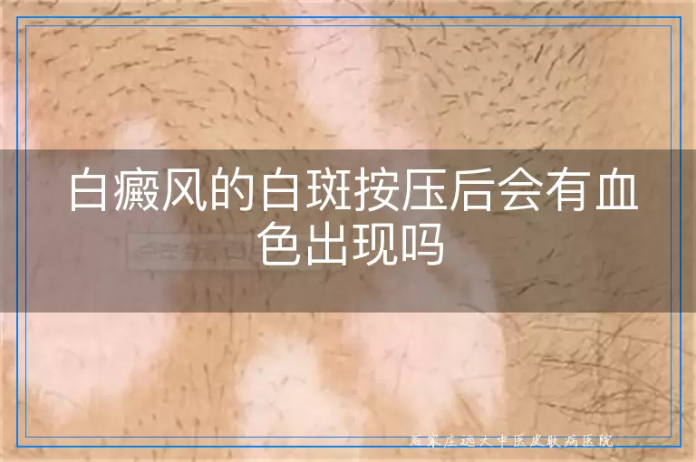 白癜风的白斑按压后会有血色出现吗