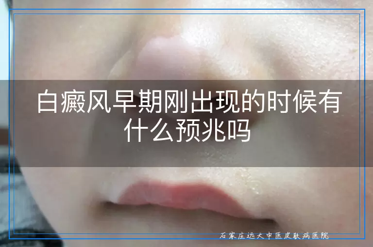 白癜风早期刚出现的时候有什么预兆吗