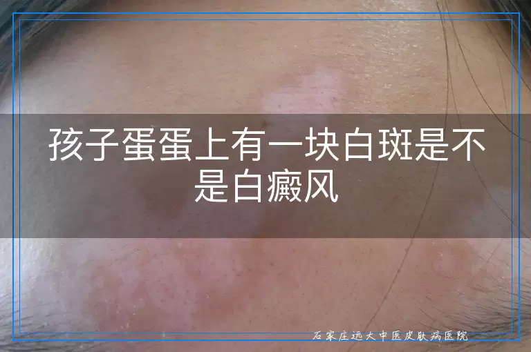 孩子蛋蛋上有一块白斑是不是白癜风