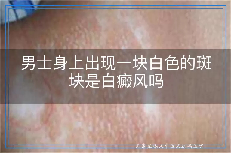 男士身上出现一块白色的斑块是白癜风吗