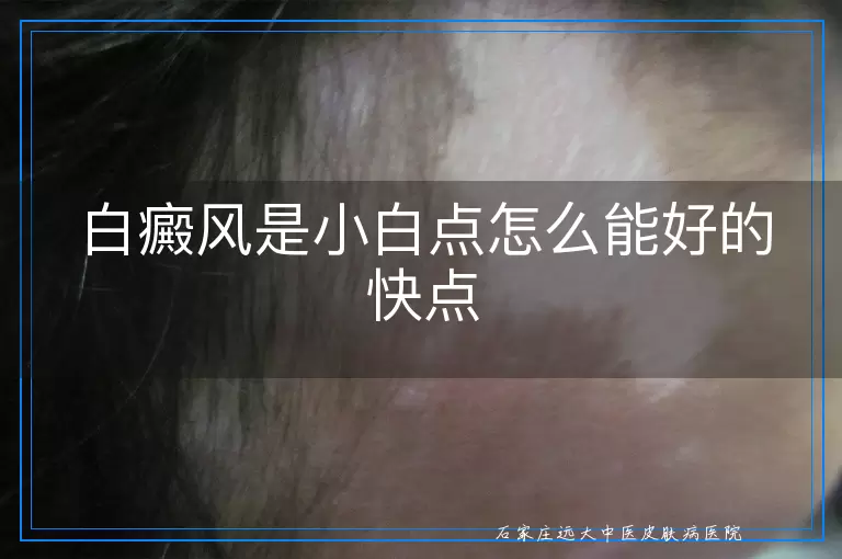 白癜风是小白点怎么能好的快点