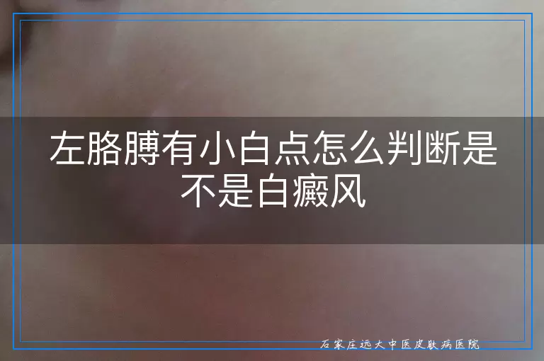 左胳膊有小白点怎么判断是不是白癜风