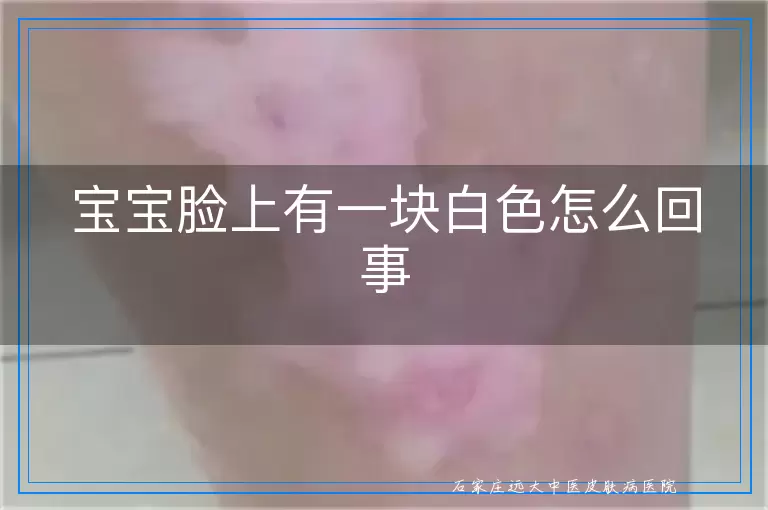 宝宝脸上有一块白色怎么回事