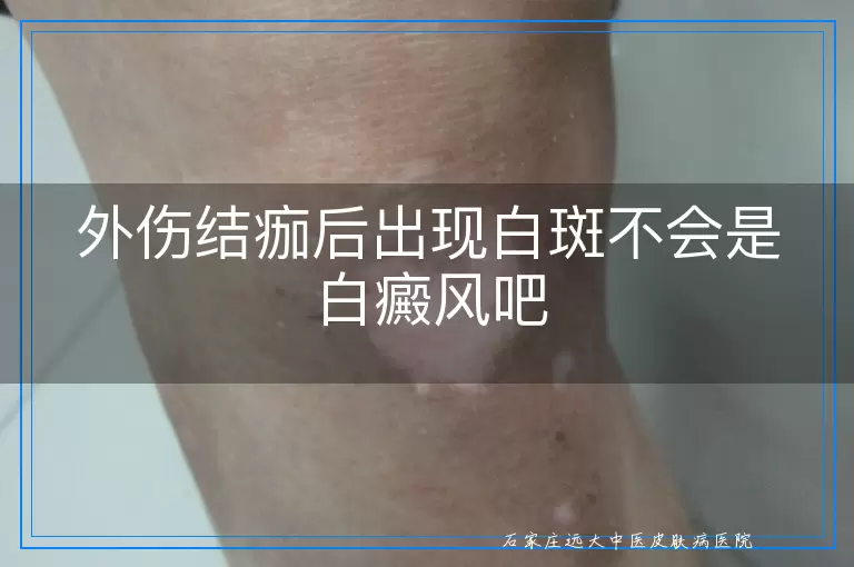 外伤结痂后出现白斑不会是白癜风吧