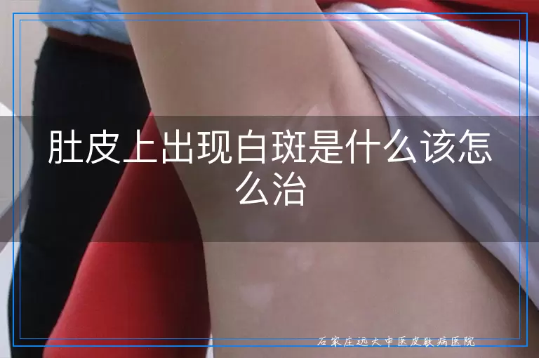 肚皮上出现白斑是什么该怎么治