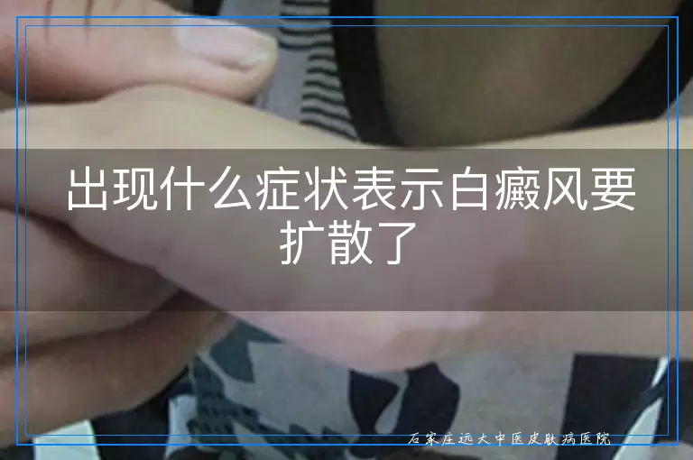 出现什么症状表示白癜风要扩散了