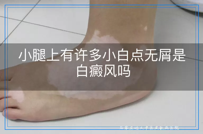 小腿上有许多小白点无屑是白癜风吗
