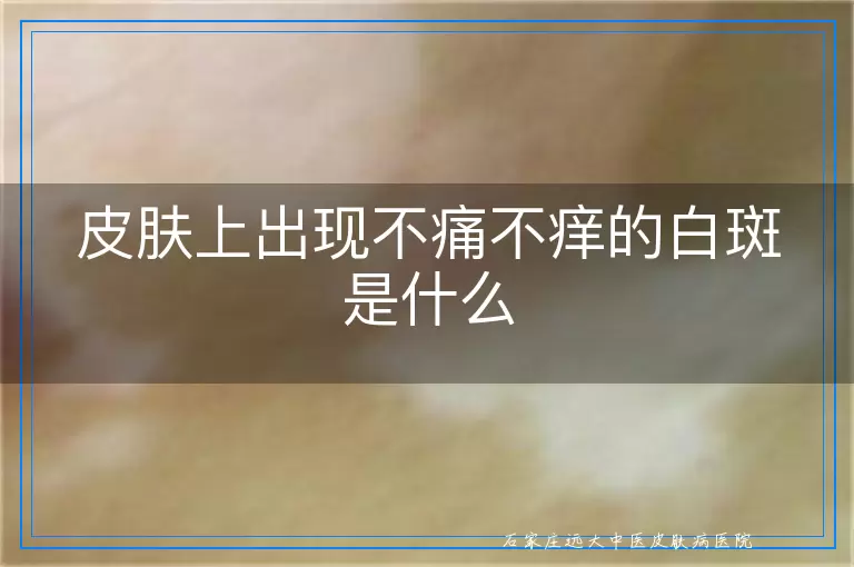 皮肤上出现不痛不痒的白斑是什么