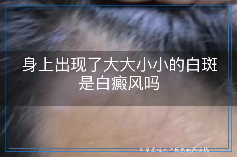 身上出现了大大小小的白斑是白癜风吗