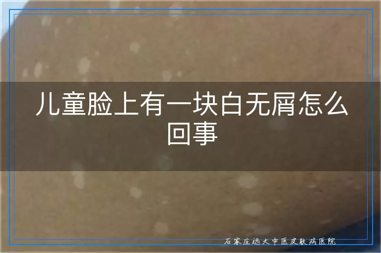 儿童脸上有一块白无屑怎么回事