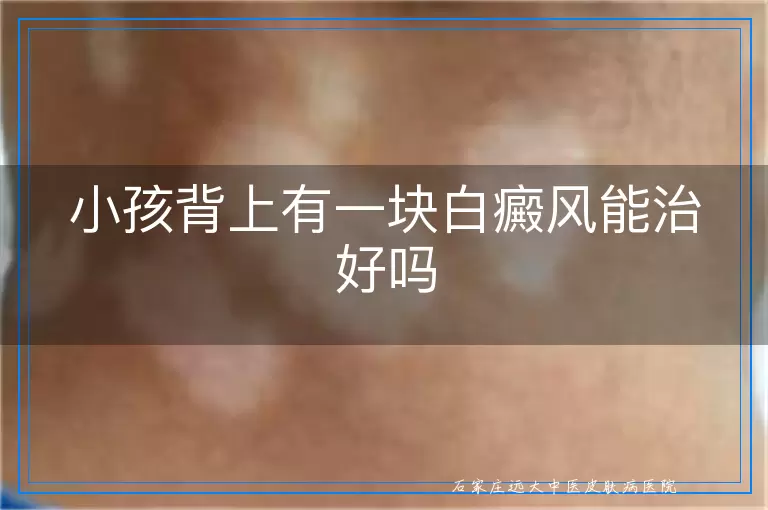 小孩背上有一块白癜风能治好吗