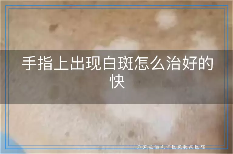 手指上出现白斑怎么治好的快