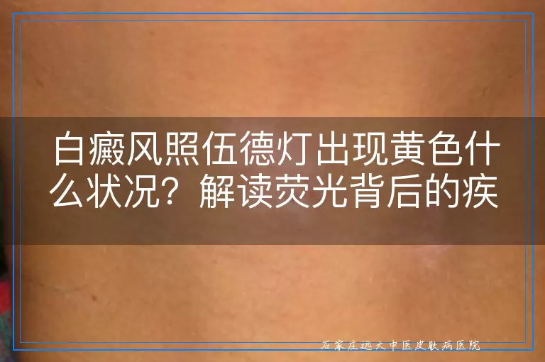 白癜风照伍德灯出现黄色什么状况？解读荧光背后的疾病信号