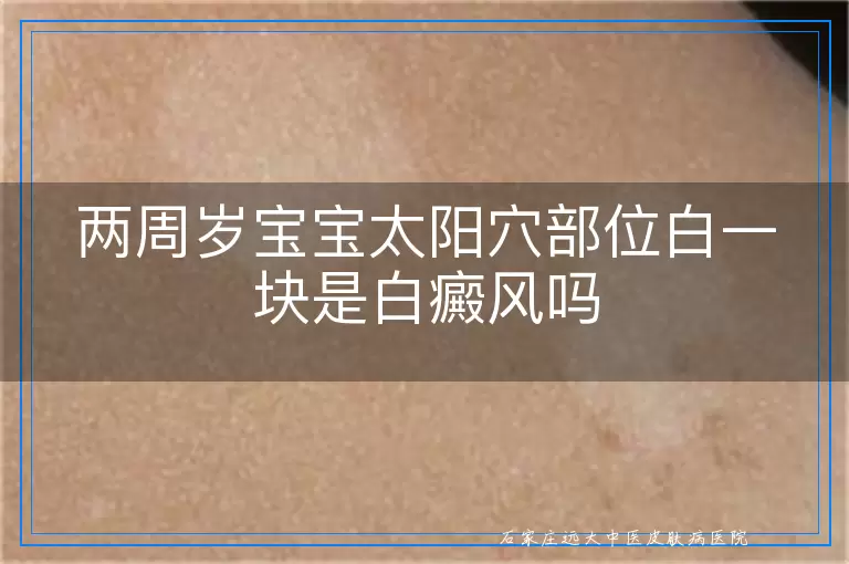 两周岁宝宝太阳穴部位白一块是白癜风吗