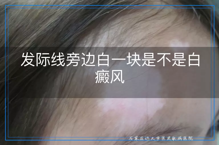 发际线旁边白一块是不是白癜风