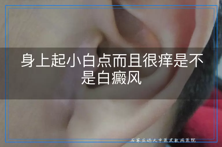 身上起小白点而且很痒是不是白癜风
