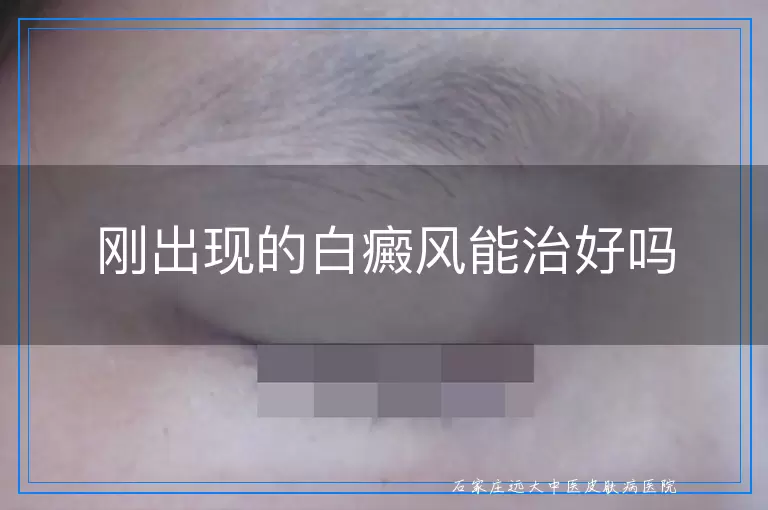 刚出现的白癜风能治好吗