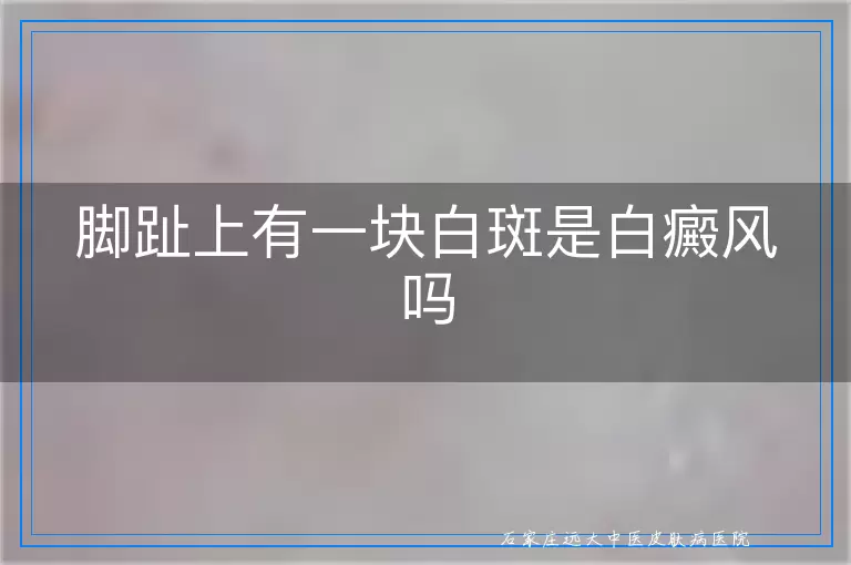 脚趾上有一块白斑是白癜风吗