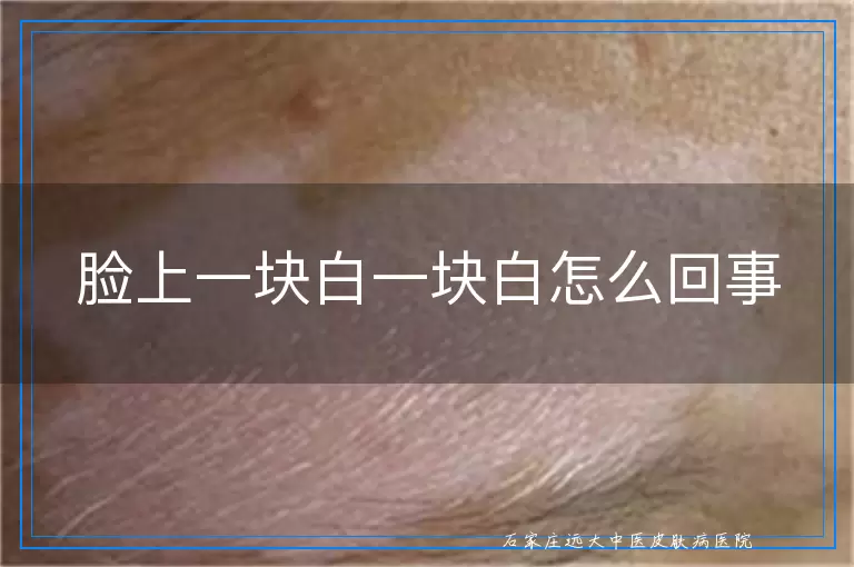 脸上一块白一块白怎么回事